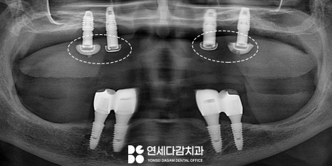 거여동 치과 임플란트 틀니 깨졌을 때 오버덴처 overdenture 종류 및 수리 기간 관련 이미지 5