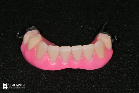 오금역 치과 부분틀니, 예후를 고려한 지대치 평가부터 정밀한 설계까지 중요한 이유 관련 이미지 7