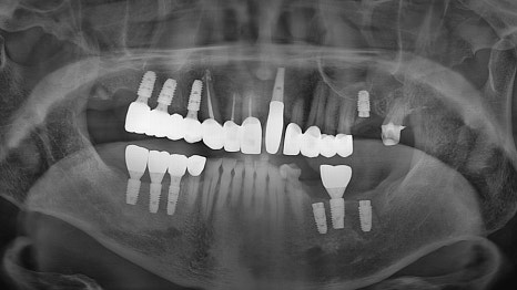 Munjung-dong Dentist: What Does Tooth Attrition Mean, What Are Its Symptoms, and How Is It Treated? image 10