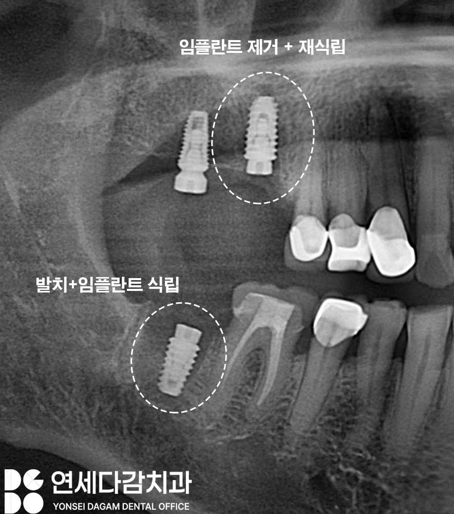 어금니 찌릿한 통증 치아에 금갔을때 신경치료 크라운 가락시장역 치과 충치 깊을 때 당일 발치 임플란트 및 부러진 보철 임플란트재식립 관련 이미지 11