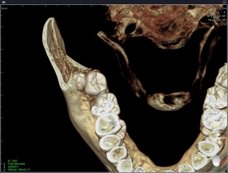 Garak-dong Wisdom Tooth Extraction: What If Two Wisdom Teeth Grew Fused Together? [A Case of Fused Wisdom Tooth Extraction] image 5
