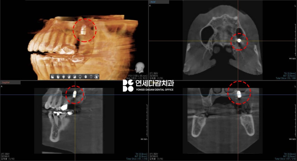 심한 염증으로 특이한 곳에 위치한 매복 사랑니 송파역 치과 에서 임플란트 수술과 함께 안전한 발치 했습니다. (feat. 상악동 천공 폐쇄술 ) 관련 이미지 5