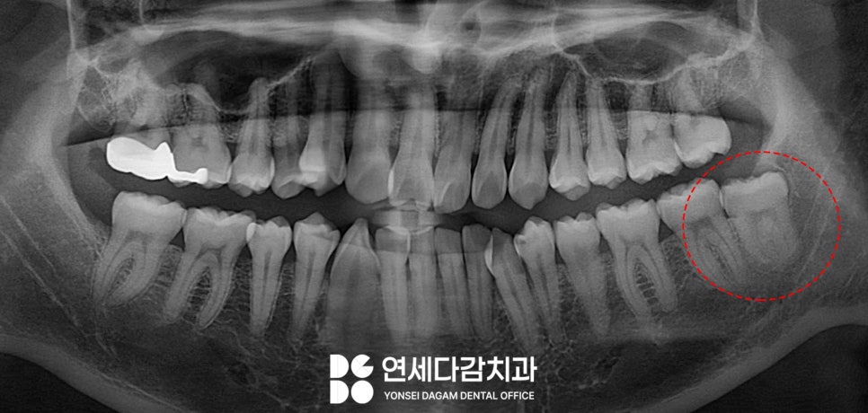 사랑니 부위 잇몸이 붓고 음식물이 자주 껴요 가락동 치과 매복사랑니 발치 후 지혈제 꼭 써야 좋을까? 관련 이미지 2