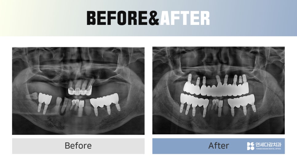 Munjeong-dong Full-Mouth Dental Implants: Why Did the Patient’s Appearance Change After Simply Replacing the Teeth? image 12