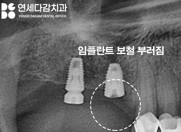 어금니 찌릿한 통증 치아에 금갔을때 신경치료 크라운 가락시장역 치과 충치 깊을 때 당일 발치 임플란트 및 부러진 보철 임플란트재식립 관련 이미지 7