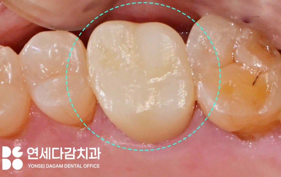 심한 이갈이 원인으로 생기는 치아 마모 및 파절 문제 문정역 치과 교모증 크라운 치료 필요한 이유 관련 이미지 5