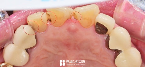 앞니 레진 후 생긴 변색 문제와 삐뚤어진 치아 개롱역 치과 최소삭제 라미네이트 적용할 수 있는 이유 관련 이미지 2