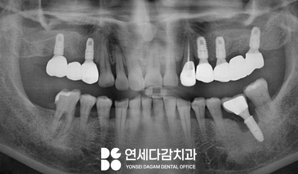 뼈가 부족해도 상악동 거상술을 통한 문정동 치과 뼈이식 임플란트 과정 관련 이미지 3