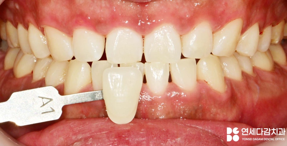 연세다감치과 심미 치료 무삭제 라미네이트 통해 자신감 있는 미소를 되찾는 여정 관련 이미지 3