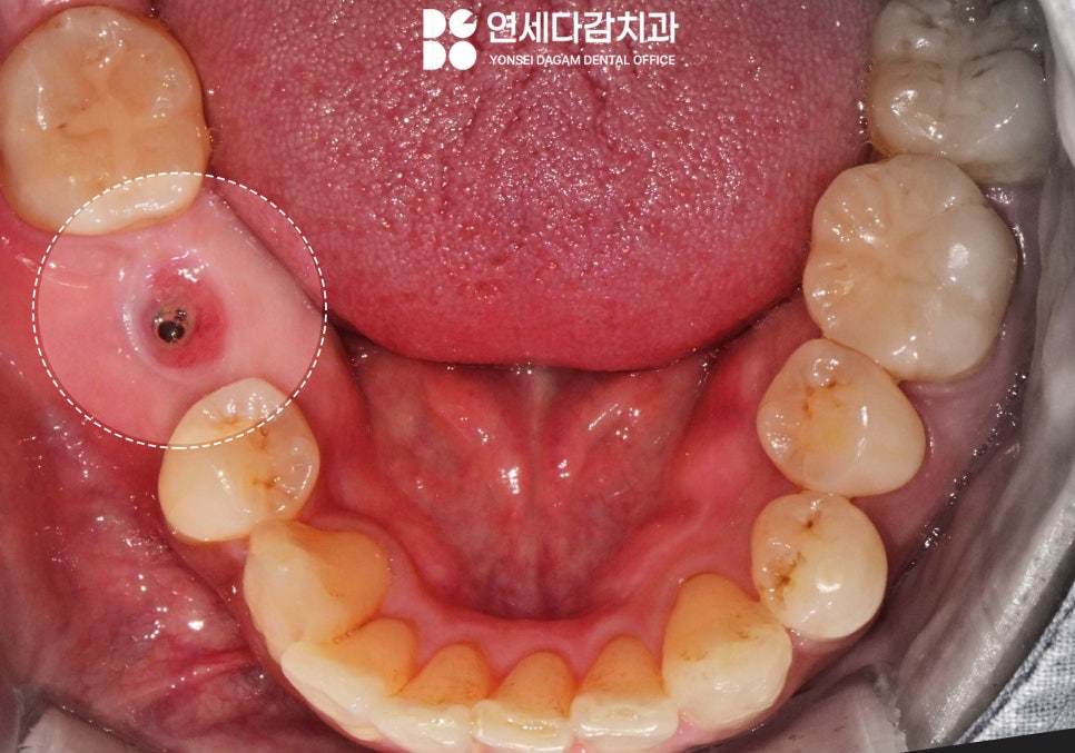 임플란트 빠짐 또는 흔들림 거여역 치과 나사 부러지고 빠졌을 때 재수술 없이 보철 크라운 교체할 수 있는 방법 관련 이미지 1