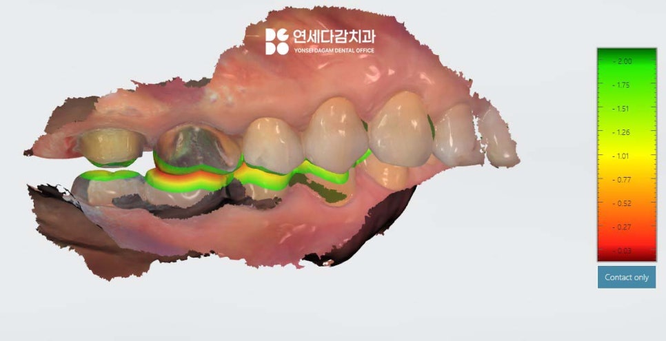 크라운 빠졌을 때 다시 붙일 수 있을까 문정동 치과 구강 스캐너 통한 보철 제작 관련 이미지 4