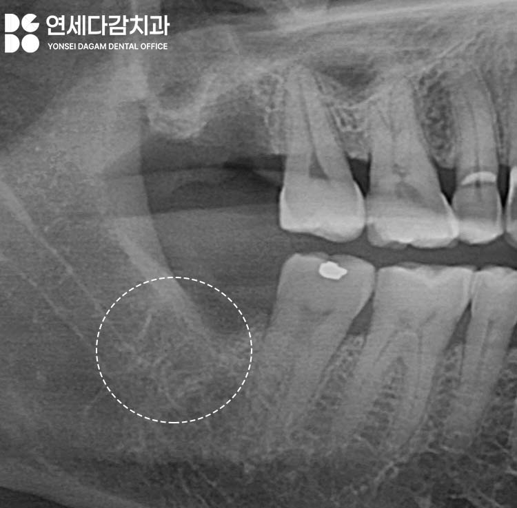 If the gums keep swelling and pus keeps coming out after impacted wisdom tooth extraction, how to find tooth root fragments remaining in the jawbone at a dental clinic in Songpa District image 7