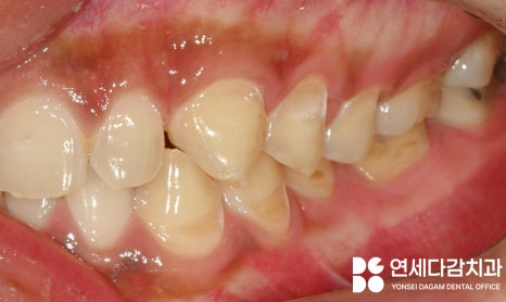 마모로 인한 치아 교모증 문정동 치과 에서 원인과 크라운 치료 방법 알려드리겠습니다. 관련 이미지 3