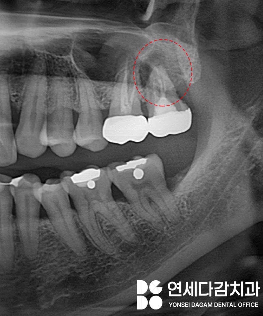 송파구 가락동 치과 공포증 완화 위한 수면마취 임플란트 의식하진정법에 사용되는 미다졸람 특징 및 장점과 부작용에 관한 이야기 관련 이미지 1