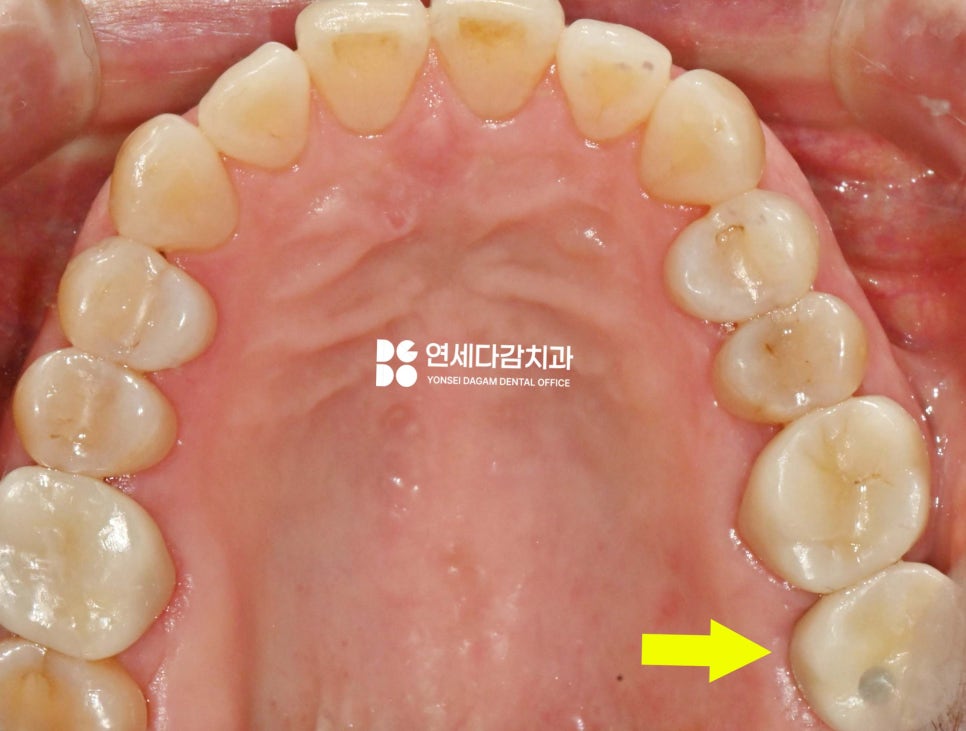 심한 염증으로 특이한 곳에 위치한 매복 사랑니 송파역 치과 에서 임플란트 수술과 함께 안전한 발치 했습니다. (feat. 상악동 천공 폐쇄술 ) 관련 이미지 8