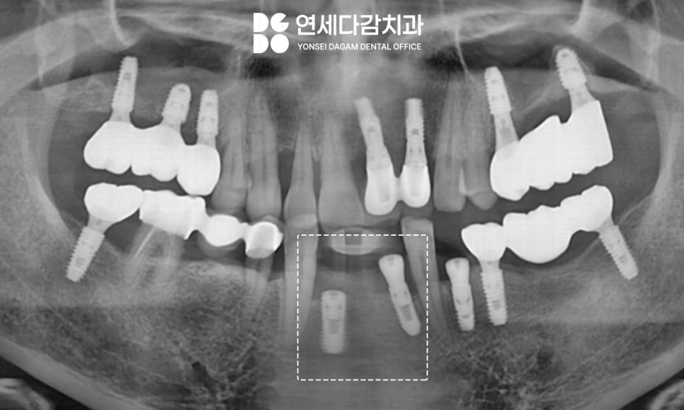 가락동 치과 오스템 임플란트 결과를 좌우하는 핵심 요소 표면처리 기술의 중요성 관련 이미지 4