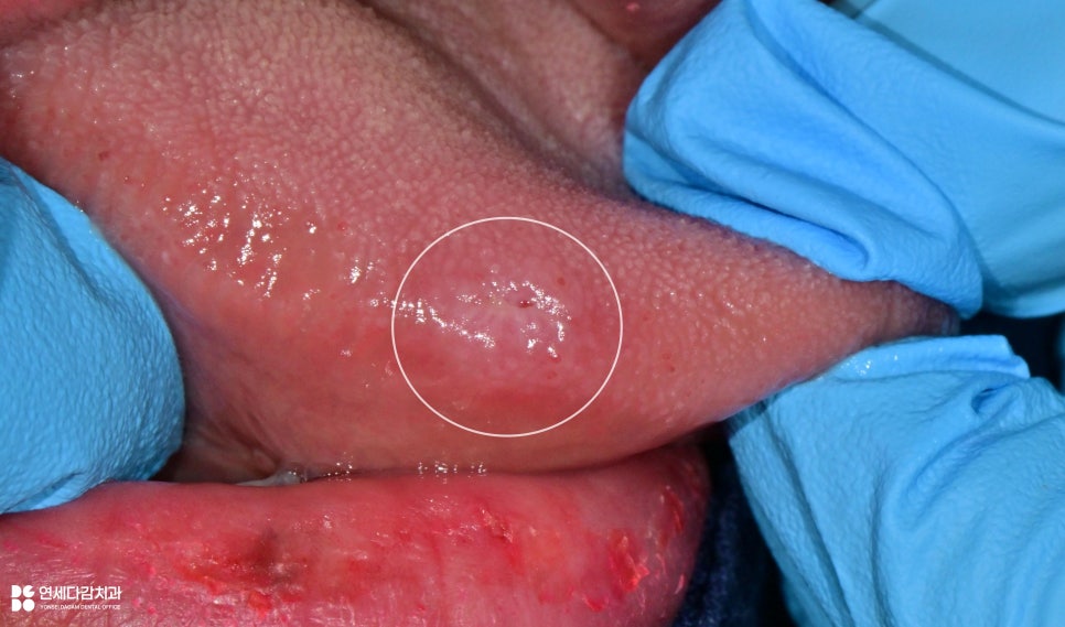 개롱역 치과 혀에 하얀 돌기? 구강 유두종 작아도 조직검사가 필요한 이유 관련 이미지 9