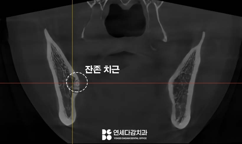 거여동 치과 매복 사랑니 발치 후 치아 뿌리 조각 부러짐 잔존치근 일부러 남겨두는 이유 관련 이미지 7