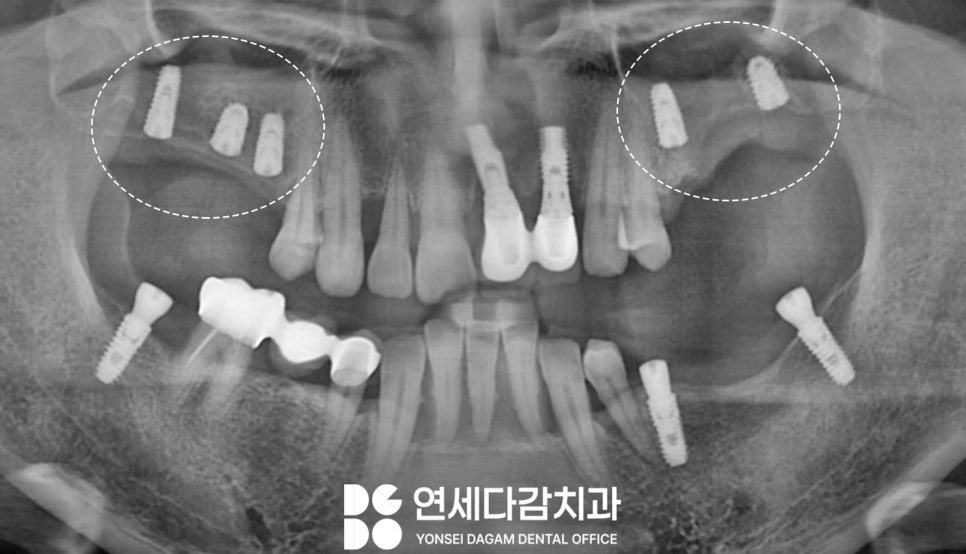 가락동 치과 오스템 임플란트 결과를 좌우하는 핵심 요소 표면처리 기술의 중요성 관련 이미지 3