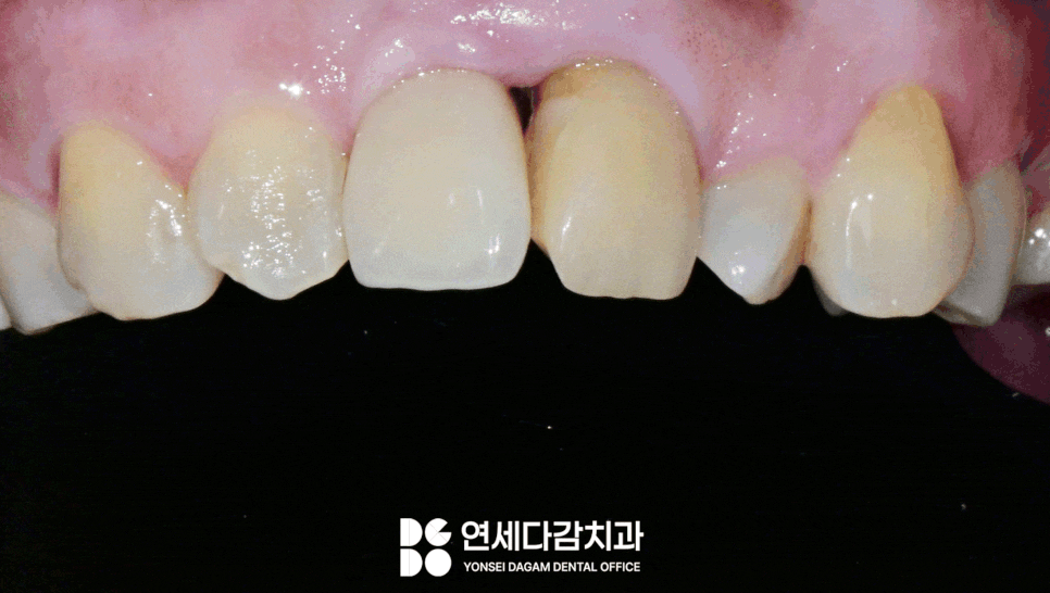 앞니 벌어짐 거여동 치과 치은성형술 동반하여 교정 없이 크라운 교체 및 최소삭제 라미네이트 통한 심미 치료 관련 이미지 6