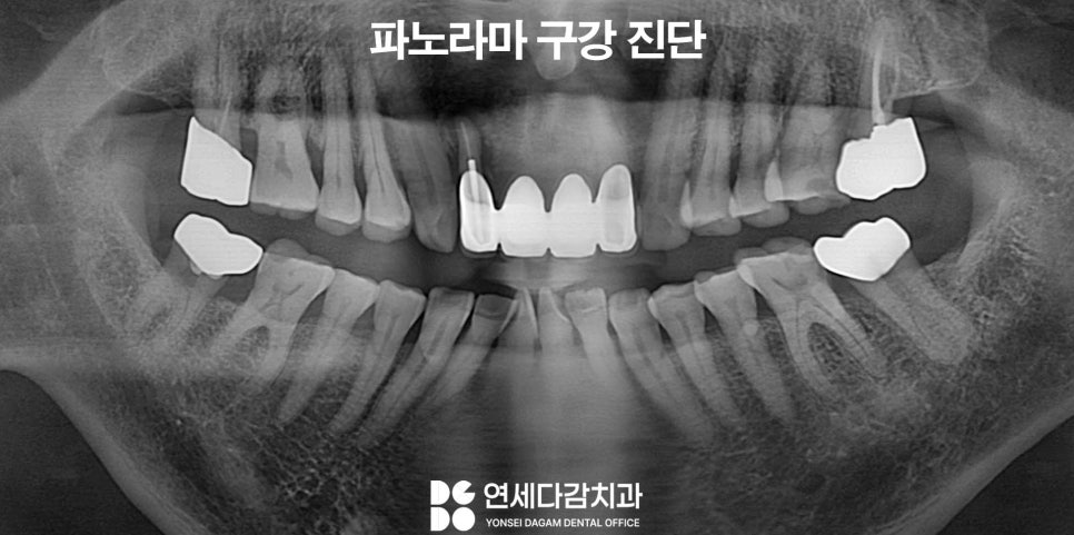 갑자기 얼굴에 찌릿한 날카로운 통증 치아 원인이 아니라면 삼차신경통 의심 문정동 치과 에서 알아보는 치료 방법 관련 이미지 1