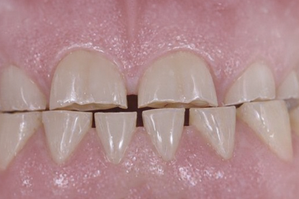 입 벌릴 때 불편하다면? 이갈이로 인한 통증 턱관절 증상 보톡스가 필요한 이유 가락동 치과 관련 이미지 1