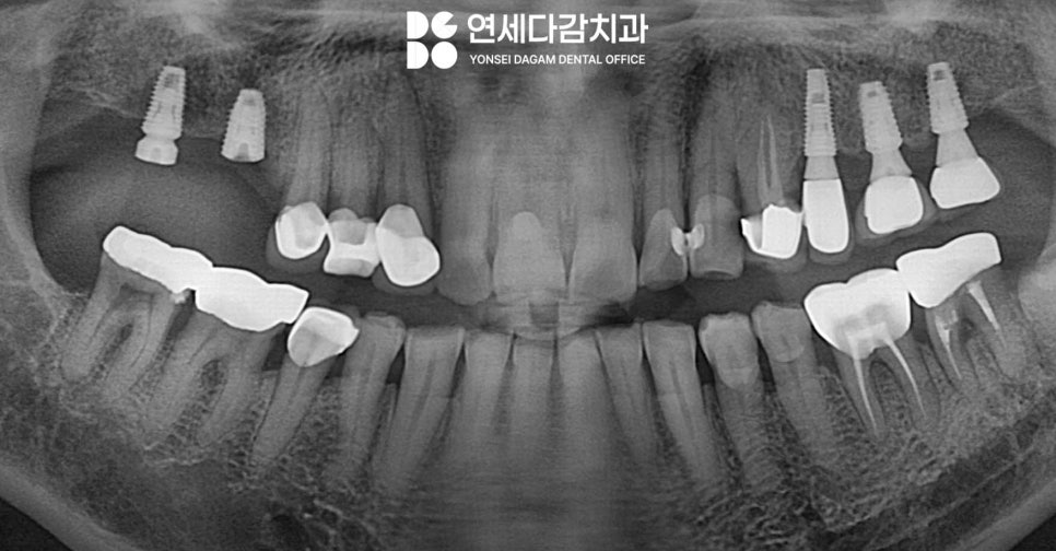 어금니 찌릿한 통증 치아에 금갔을때 신경치료 크라운 가락시장역 치과 충치 깊을 때 당일 발치 임플란트 및 부러진 보철 임플란트재식립 관련 이미지 1