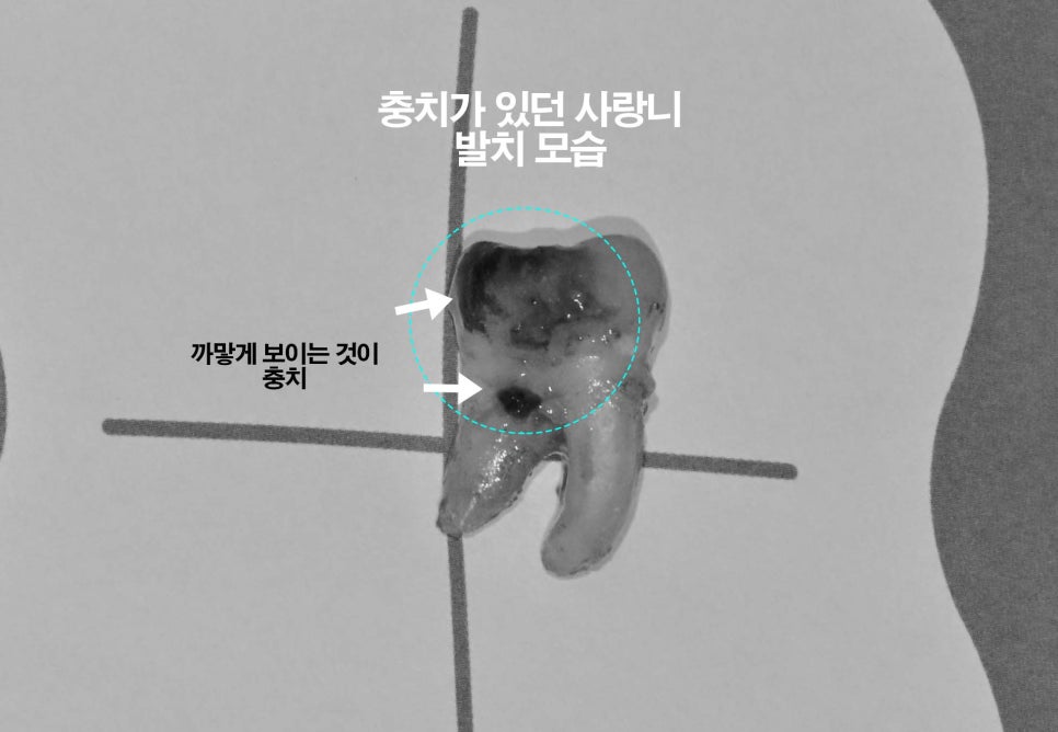 상악동 또는 신경 가까운 누워있는 매복 사랑니 가락시장역 치과 단순 발치를 위한 필수 CT 분석 과정 관련 이미지 7