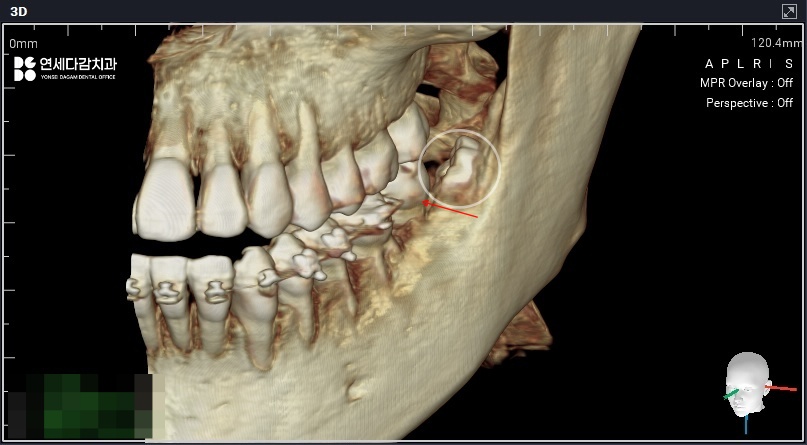 가락동 치과 교정 치료 전 사랑니 발치 꼭 필요할까? - 미성숙 매복케이스로 알아보는 과정 관련 이미지 4