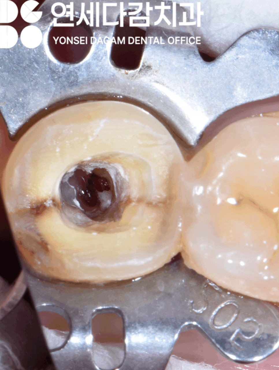 어금니 깨짐, 치아에 금 갔을 때 찌릿한 통증 가락시장역 치과 신경치료 후 크라운 꼭 씌워야 되는 이유와 예방법 관련 이미지 6