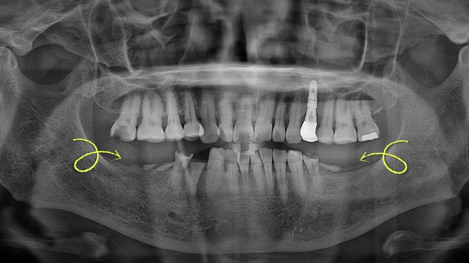 Munjeong-dong Dental Clinic, Bone Graft Implant Process&middot; What If You’ve Lost a Molar? image 2