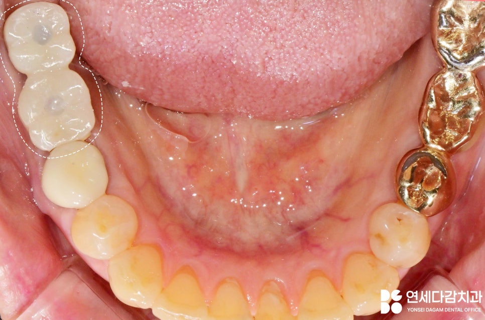 오래된 임플란트 다시 수술하지 않고 크라운 교체만 가능할까 문정동 치과 SCRP 타입으로 보철 재제작 관련 이미지 9