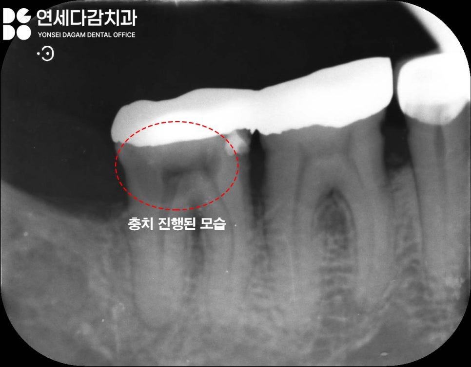어금니 찌릿한 통증 치아에 금갔을때 신경치료 크라운 가락시장역 치과 충치 깊을 때 당일 발치 임플란트 및 부러진 보철 임플란트재식립 관련 이미지 4
