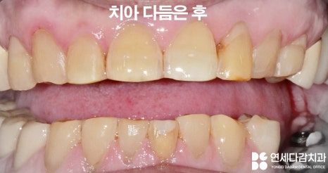 하얀 치아가 가져오는 인상의 변화 오금동 치과 교정 없이 최소삭제 라미네이트 심미치료 통해 치열 및 누렁니 개선 관련 이미지 5