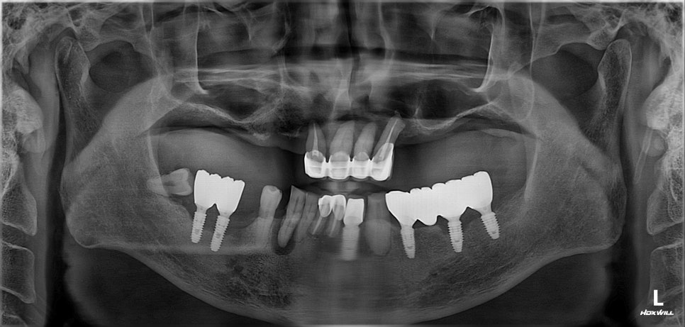 Munjeong-dong Full-Mouth Dental Implants: Why Did the Patient’s Appearance Change After Simply Replacing the Teeth? image 2