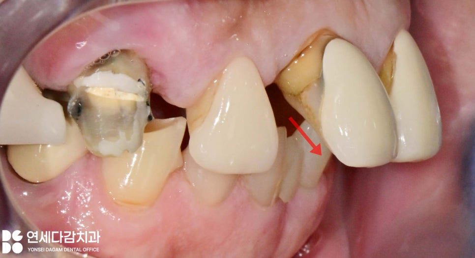 치주염 원인으로 치아 흔들림 오금동 치과 크라운 치료 통해 뻐드러진 앞니 돌출입 해소 과정에서 잇몸치료 필요한 이유 관련 이미지 2