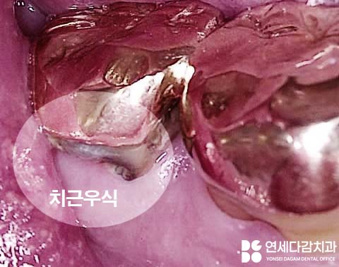 어금니 찌릿한 통증 치아에 금갔을때 신경치료 크라운 가락시장역 치과 충치 깊을 때 당일 발치 임플란트 및 부러진 보철 임플란트재식립 관련 이미지 5