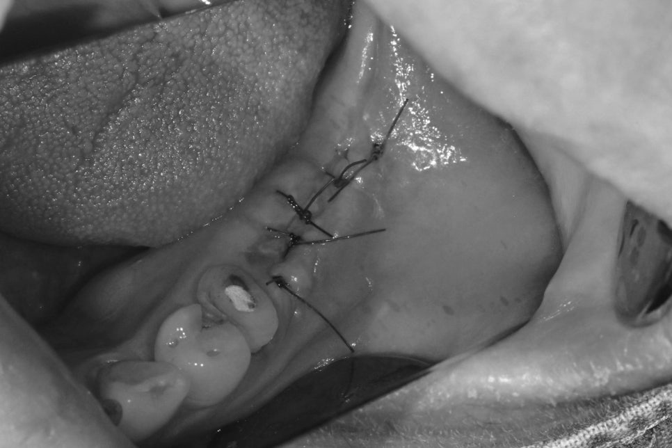 Munjeong-dong Dental Clinic, Bone Graft Implant Process&middot; What If You’ve Lost a Molar? image 7