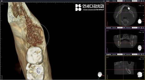 If the gums keep swelling and pus keeps coming out after impacted wisdom tooth extraction, how to find tooth root fragments remaining in the jawbone at a dental clinic in Songpa District image 5