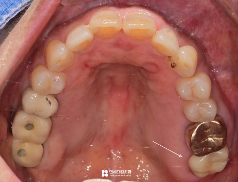 개롱역치과 아프기 전에 발견해야 되는 이유 인접면 충치 치료 관련 이미지 7