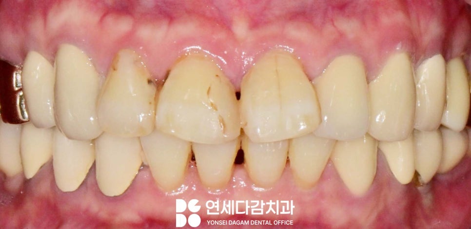 앞니 레진 후 생긴 변색 문제와 삐뚤어진 치아 개롱역 치과 최소삭제 라미네이트 적용할 수 있는 이유 관련 이미지 1