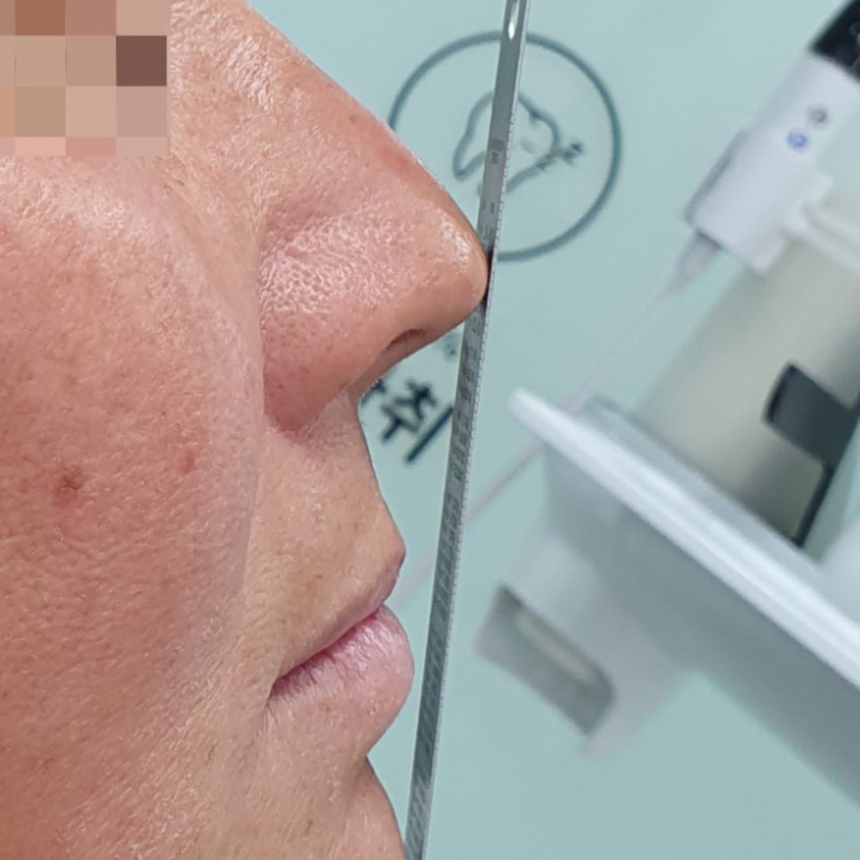 Munjeong-dong Full-Mouth Dental Implants: Why Did the Patient’s Appearance Change After Simply Replacing the Teeth? image 8