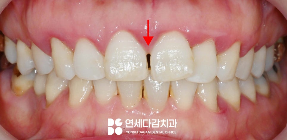 앞니 사이 벌어짐, 틈(치간이개) 문정역 치과 에서 선택하는 치료 방법 관련 이미지 1