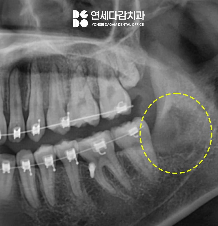 교정 중 사랑니 발치 진단 오금동 치과 에서 설측 수평 매복 발치 과정 알려드리겠습니다. 관련 이미지 5
