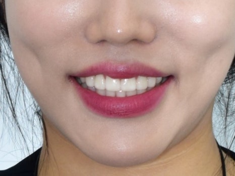 연세다감치과의 치아 깍지 않는 무삭제 라미네이트 (시술 후 변화와 관리법) 관련 이미지 6