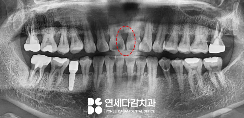 앞니 사이 벌어짐, 틈(치간이개) 문정역 치과 에서 선택하는 치료 방법 관련 이미지 2