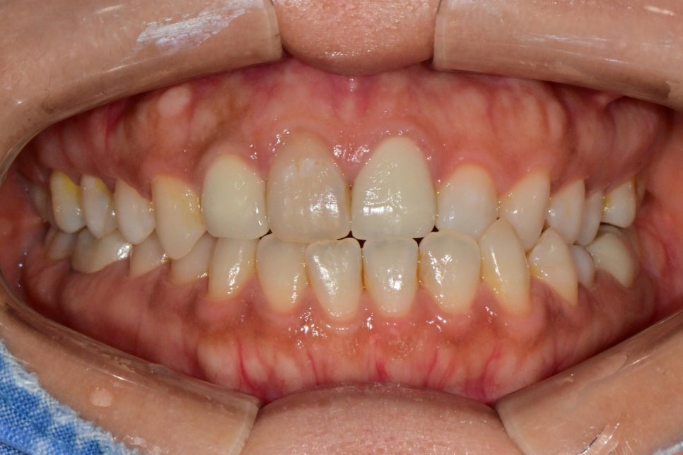 Macheon-dong Dental Clinic: Why Treating Root Inflammation Comes First Before an Anterior Crown image 1