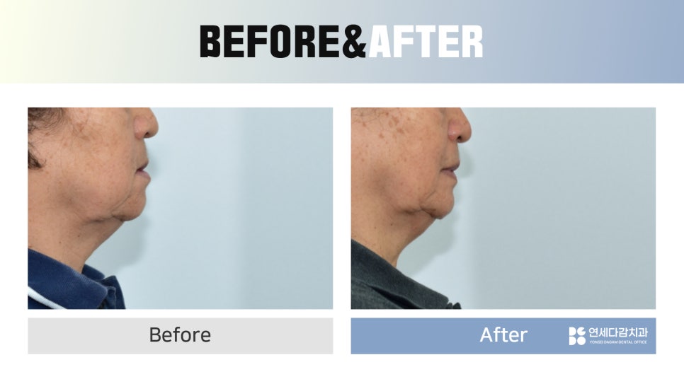 Seokchon-dong Dental Clinic, 연세다감치과: Why You Should Carefully Review the Denture-Making Steps · Process from the Beginning image 5