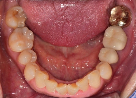 개롱역치과 아프기 전에 발견해야 되는 이유 인접면 충치 치료 관련 이미지 2