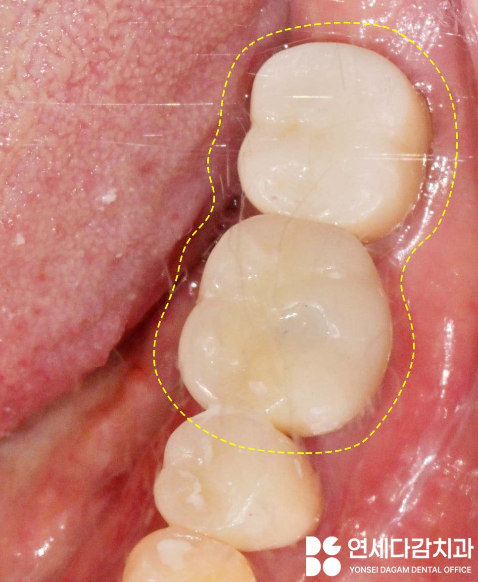 개롱역 치과 오스템 임플란트 종류의 다양성과 형태 구분법, 이것을 이용한 재수술 없는 보철 치료 관련 이미지 8
